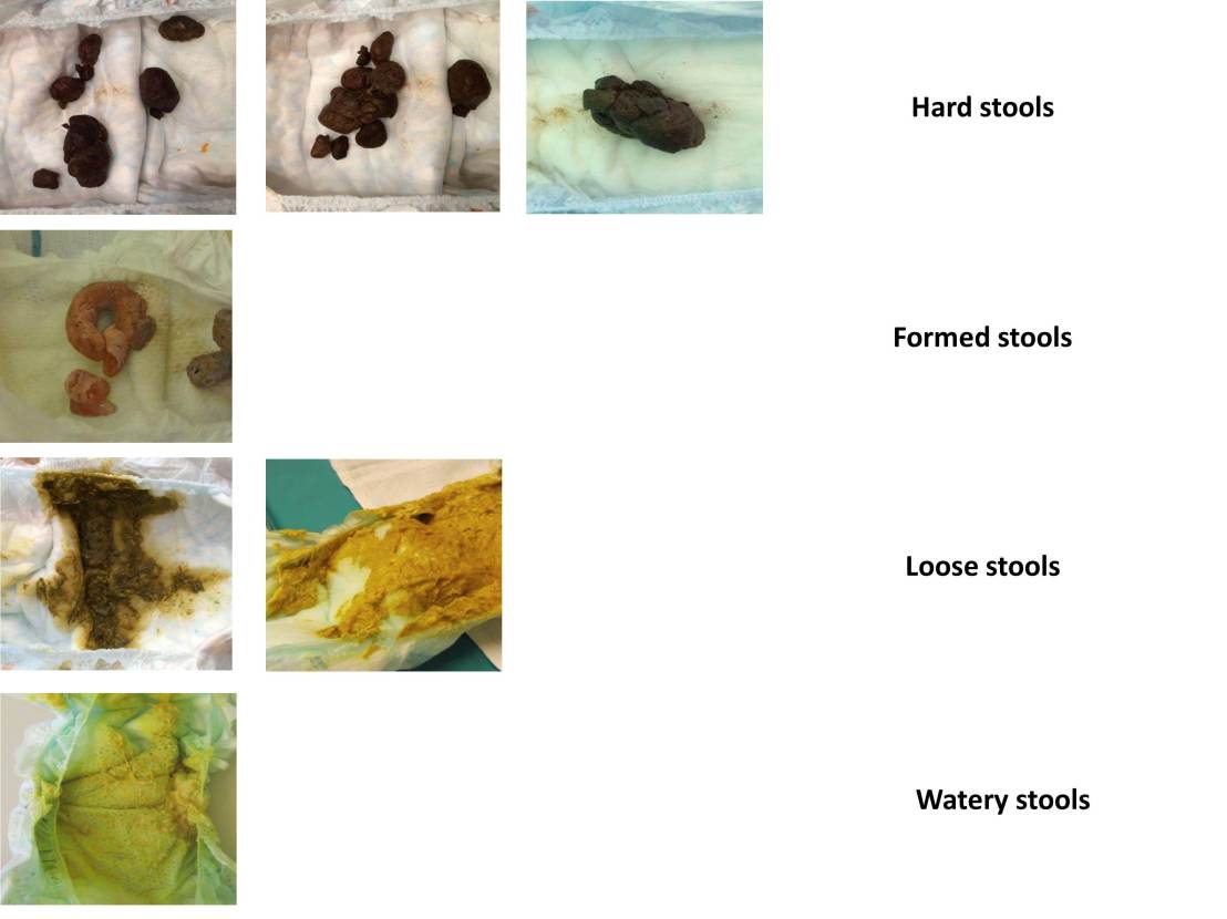 The Brussels Infant and Toddler Stool Scale (BITSS) The Brussels